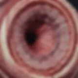 Illustration of rectal carcinoid tumor histology